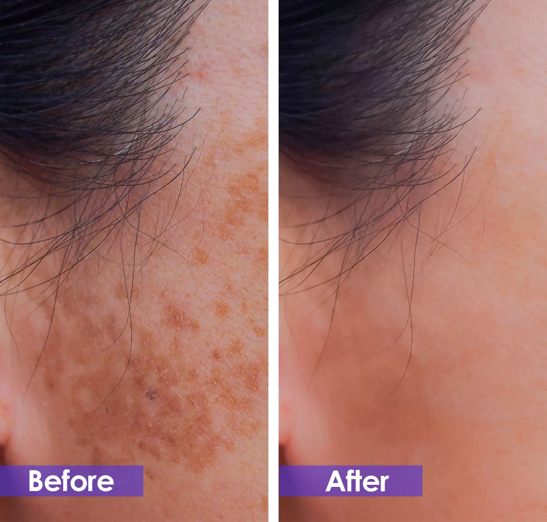 sunburn spots removal before and after